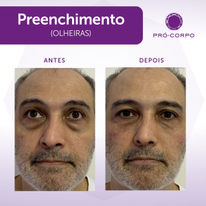 Olheiras Fotos Antes e Depois